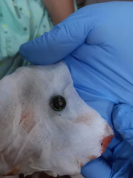 Cận cảnh “hung thủ” gây đau đớn cho bé Scarlett Chavez