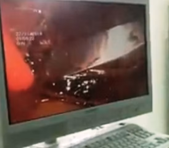 Con dao găm dài hơn 10cm đâm xuyên lồng ngực vào phổ bệnh nhân.