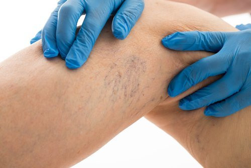 Bí quyết giúp giảm đau do giãn tĩnh mạch chân Bí quyết giúp giảm đau do giãn tĩnh mạch chân