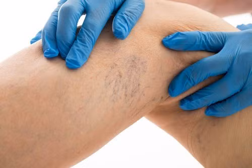 Bí quyết giúp giảm đau do giãn tĩnh mạch chân