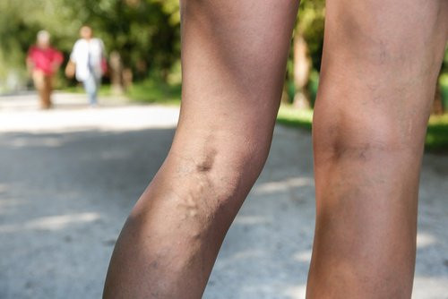 Bí quyết giúp giảm đau do giãn tĩnh mạch chân Bí quyết giúp giảm đau do giãn tĩnh mạch chân