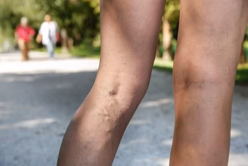 Bí quyết giúp giảm đau do giãn tĩnh mạch chân