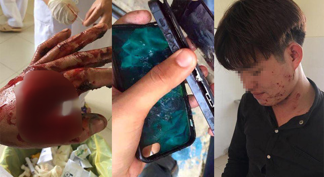 Thanh niên bị dập nát bàn tay khi sử dụng điện thoại đang sạc pin