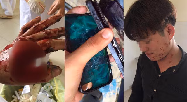 Thanh niên bị dập nát bàn tay khi sử dụng điện thoại đang sạc pin