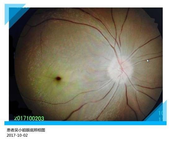 Cô gái trẻ bị mù một bên mắt và lời cảnh tỉnh cho những ai không muốn rời mắt khỏi màn hình điện thoại - Ảnh 4. Cô gái trẻ bị mù một bên mắt và lời cảnh tỉnh cho những ai không muốn rời mắt khỏi màn hình điện thoại - Ảnh 4.
