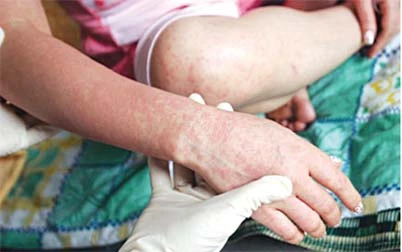 Khi đến thăm, chăm con bị sởi nhiều người lớn có thể bị lây hoặc mang virus lây lan ra ngoài cộng đồng.