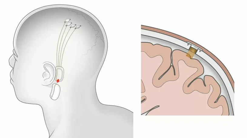 Cuộc sống muôn màu: Liên kết não người với máy tính