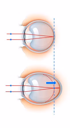 Bé gái 2 tuổi đã cận thị… 600 độ vì thường xuyên được bố mẹ cho làm việc này 5 giờ mỗi ngày - Ảnh 3.