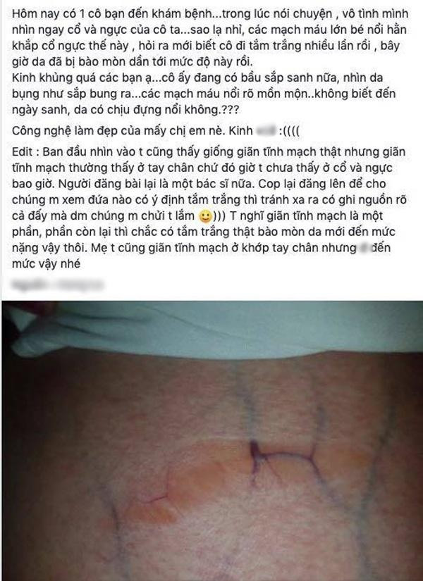 Lạm dụng tắm trắng, cô gái hoảng hốt thấy làn da biến đổi đáng sợ