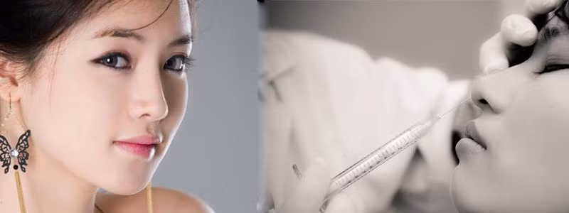 Nâng mũi bằng filler chỉ có tác dụng trong thời gian ngắn bên cạnh nhiều biến chứng hoại tử.