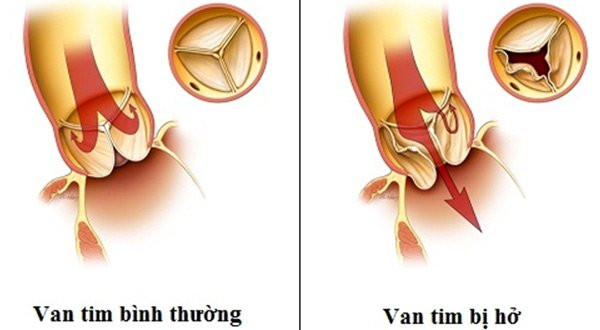 ca si tuan hung bi ho van tim, can benh nay lieu co nguy hiem? - 3