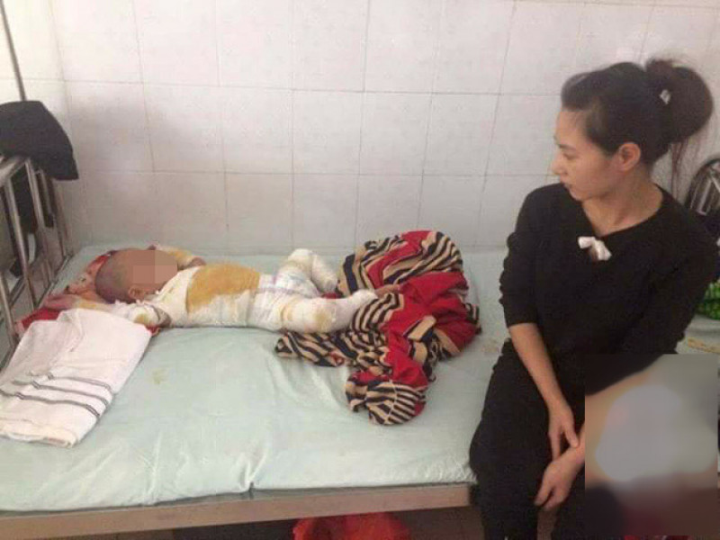 Mẹ bất cẩn khiến bé trai 2 tuổi ngã vào nồi nước sôi