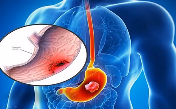 Thiếu nữ 18 tuổi đau bụng nhẹ đi khám phát hiện ung thư dạ dày giai đoạn cuối-1