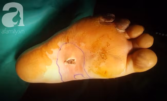 Tự mua thuốc trị tiểu đường, người phụ nữ nguy kịch vì nhồi máu cơ tim