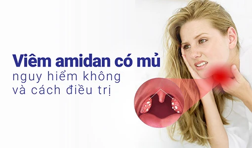 Viêm amidan có mủ cần được nhận biết và điều trị kịp thời.