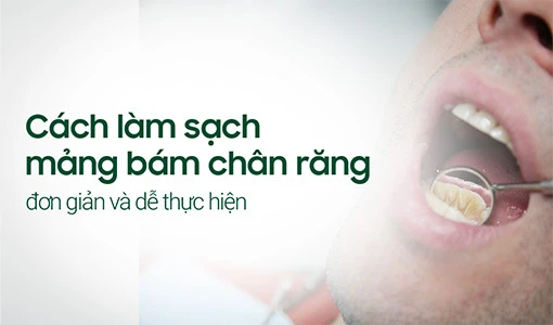 Làm sạch mảng bám chân răng giúp bảo vệ răng tốt hơn.