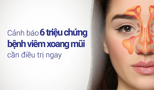 Nhận biết triệu chứng bệnh viêm xoang mũi giúp điều trị chính xác.