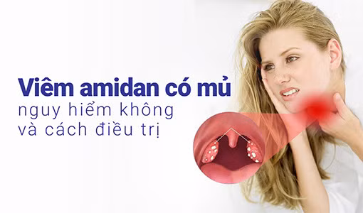 Viêm amidan có mủ cần được nhận biết và điều trị kịp thời.