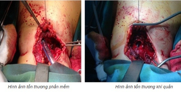 đứt khí quản đứt khí quản