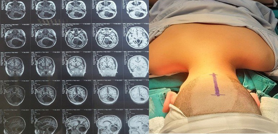 Bệnh nhi bị u tiểu não được mổ trong tư thế nằm sấp. Bệnh nhi bị u tiểu não được mổ trong tư thế nằm sấp.