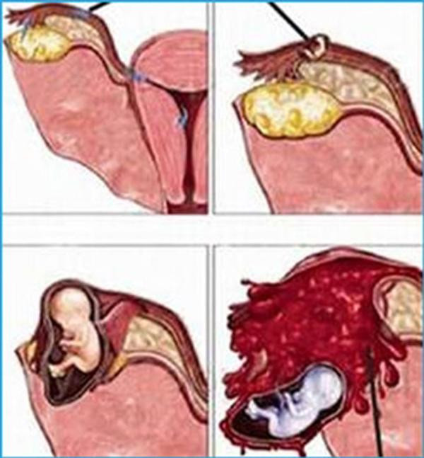 Thử que lên 2 vạch, mẹ Cần Thơ siêu âm mấy lần không thấy thai cho đến khi... ảnh 1 thu que len 2 vach, me can tho sieu am may lan khong thay thai cho den khi... - 1