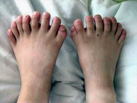 Những bức ảnh về chân và tay người dị dạng 7 Những bức ảnh về chân và tay người dị dạng 7
