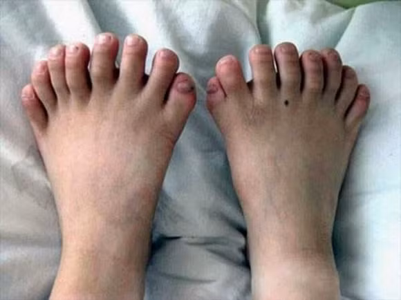 Những bức ảnh về chân và tay người dị dạng 7