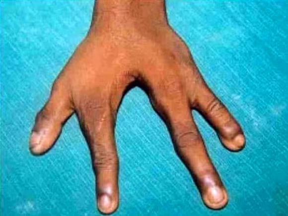 Những bức ảnh về chân và tay người dị dạng 16