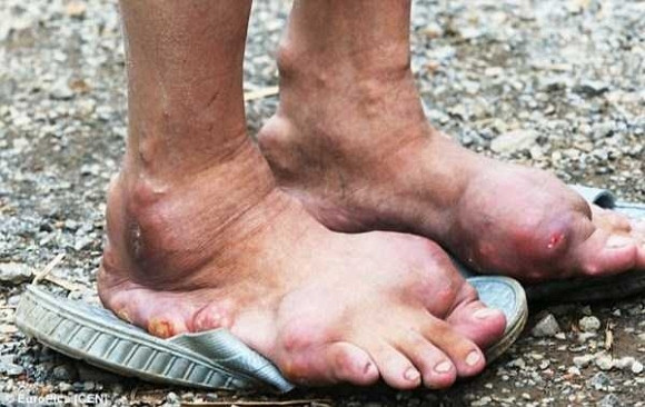 Những bức ảnh về chân và tay người dị dạng 5 Những bức ảnh về chân và tay người dị dạng 5