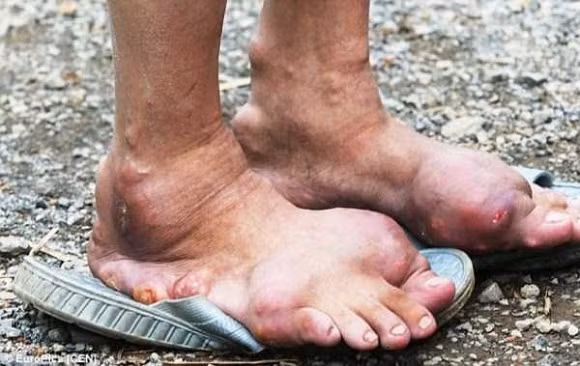 Những bức ảnh về chân và tay người dị dạng 5