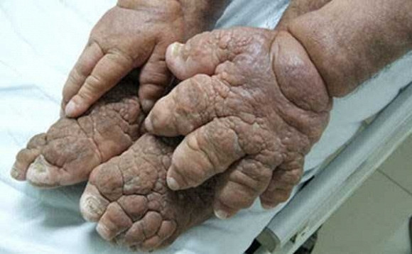 Những bức ảnh về chân và tay người dị dạng đáng sợ