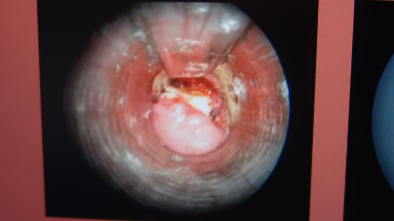 Tưởng bị viêm phế quản, 10 tháng sau người phụ nữ ngỡ ngàng biết sự thật ảnh 2 ho lien tuc tuong bi viem phe quan, 10 thang sau nguoi phu nu ngo ngang khi biet su that - 2