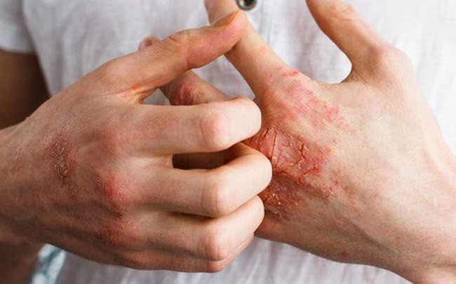 Bé 11 tuổi bị dị ứng thực phẩm đã tử vong sau khi hít mùi cá nấu - Ảnh 3. Bé 11 tuổi bị dị ứng thực phẩm đã tử vong sau khi hít mùi cá nấu - Ảnh 3.