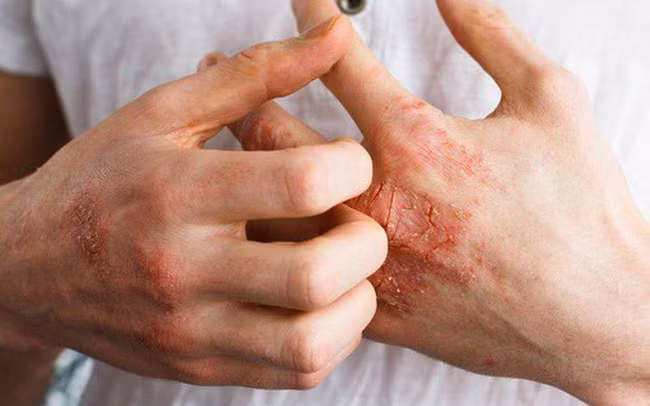 Bé 11 tuổi bị dị ứng thực phẩm đã tử vong sau khi hít mùi cá nấu - Ảnh 3.