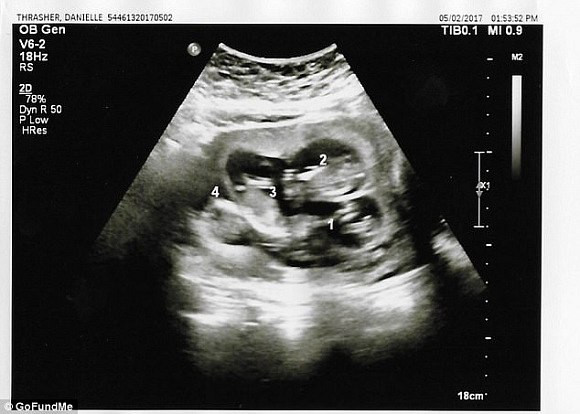 Mỗi lần siêu âm, người phụ nữ này lại phát hiện thêm một em bé trong bụng ảnh 2 Mỗi lần siêu âm, người phụ nữ này lại phát hiện thêm một em bé trong bụng - Hình 2