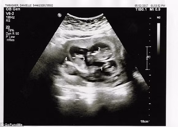 Mỗi lần siêu âm, người phụ nữ này lại phát hiện thêm một em bé trong bụng - Hình 2