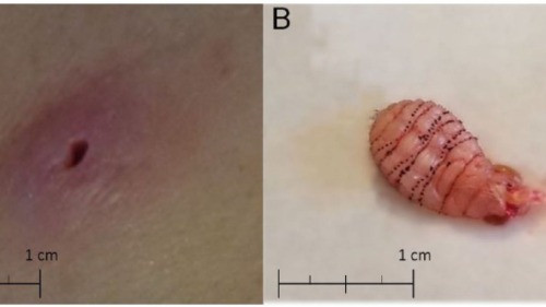 Vết cắn trên cơ thể nữ bệnh nhân và con ấu trùng ký sinh bên dưới. Ảnh: Journal Investig Med High Case Rep.