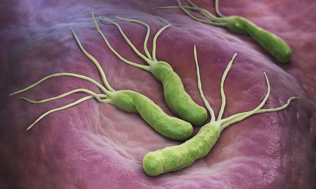  Nhiễm khuẩn HP (Helicobacter Pylori) 