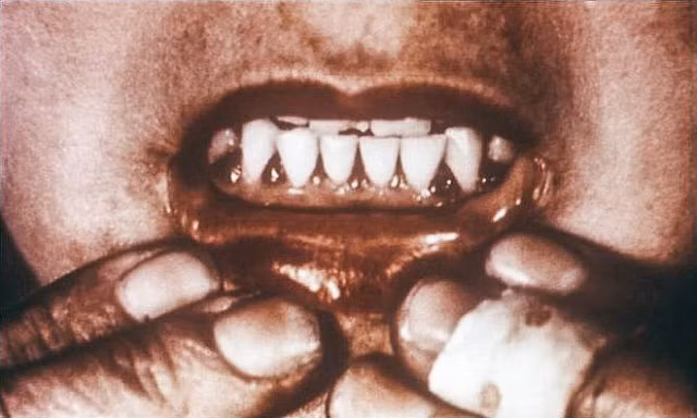 Căn bệnh bí ẩn từng giết hàng loạt hải tặc vào thế kỷ 18 đang dần xuất hiện - Hình 3