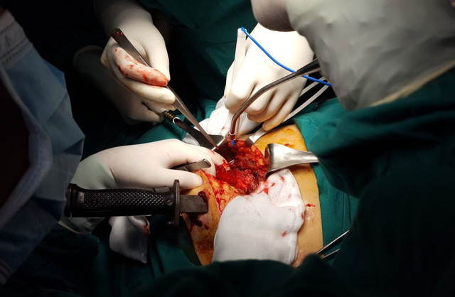 Cân não giành lại sự sống cho bệnh nhân bị dao cắm xuyên ngực ảnh 1 Bệnh nhân nhập viện với con đang đâm xuyên thấu ngực trái