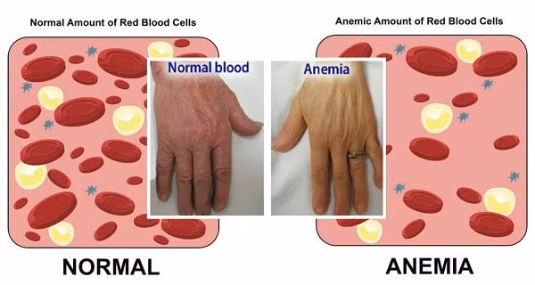 Nếu bạn thường xuyên mệt mỏi, hãy cẩn trọng vì có thể bạn đang gặp phải 1 trong 4 bệnh này - Ảnh 2.