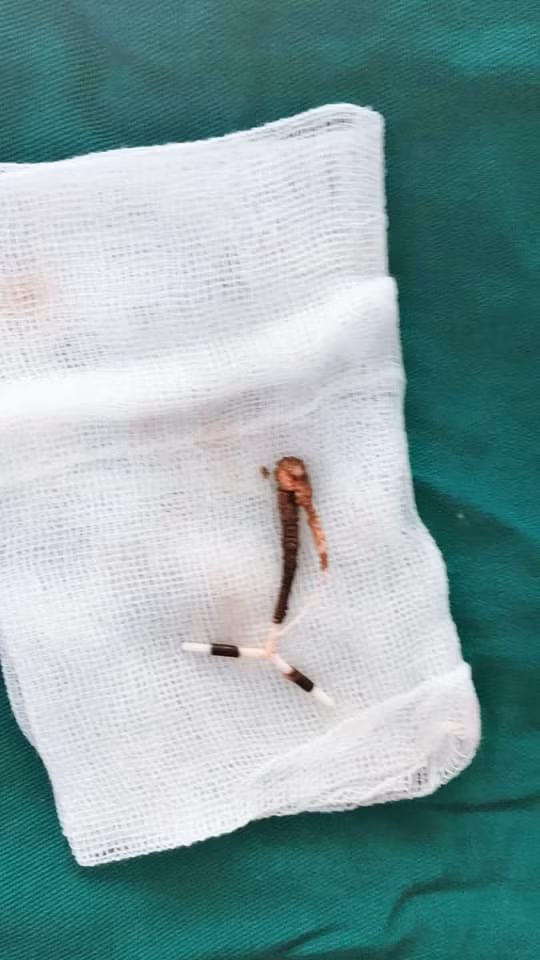 Vòng tránh thai được gắp ra từ bàng quang bệnh nhân.