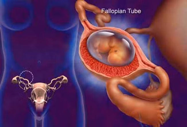 Người phụ nữ suýt mất mạng vì tự ý dùng thuốc và massage khi đau bụng, cảnh báo phụ nữ trong tuổi sinh đẻ cần chú ý - Ảnh 2.