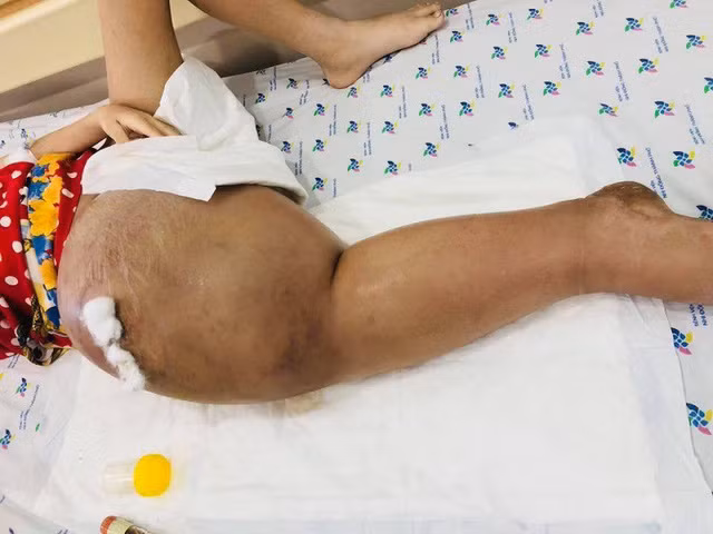 Chân phải của bệnh nhi sưng phù do ung thư xương nhưng không được điều trị kịp thời