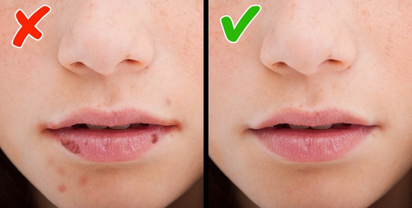 Chốc mép Chốc mép là hiện tượng dễ gặp khi cơ thể thiếu vitamin B2, B3, B12, các vitamin giàu sắt và kẽm. Nên ăn nhiều cá (cá hồi, cá ngừ), thịt gia cầm, trứng, đậu và các loại hạt. Chốc mép Chốc mép là hiện tượng dễ gặp khi cơ thể thiếu vitamin B2, B3, B12, các vitamin giàu sắt và kẽm. Nên ăn nhiều cá (cá hồi, cá ngừ), thịt gia cầm, trứng, đậu và các loại hạt.