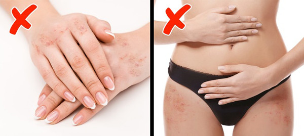 Nổi mẩn ở tay và hông Các vết đỏ như mụn trứng cá xuất hiện ở tay và hông do thiếu vitamin A, D và các axit béo. Nên ăn nhiều cà rốt, ớt đỏ, cá hồi và cắt giảm các thực phẩm chứa chất béo chuyển hóa. Nổi mẩn ở tay và hông Các vết đỏ như mụn trứng cá xuất hiện ở tay và hông do thiếu vitamin A, D và các axit béo. Nên ăn nhiều cà rốt, ớt đỏ, cá hồi và cắt giảm các thực phẩm chứa chất béo chuyển hóa.