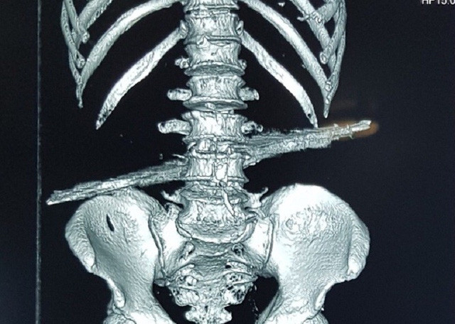 Bác sĩ cưa cây sắt tại hiện trường, cứu cụ ông bị đâm xuyên bụng ảnh 1 Hình ảnh trên phim cho thấy cây sắt đâm xuyên bụng làm vỡ bản sống của người bệnh