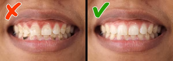 Viêm nha chuNgoài vấn đề vệ sinh răng miệng kém hoặc hút quá nhiều thuốc, thiếu hụt vitamin D cũng dẫn đến viêm nha chu. Nên ăn nhiềucác sản phẩm từ sữa, gạo nâu, cà chua, đậu, cá, cam, quýt, và nho.