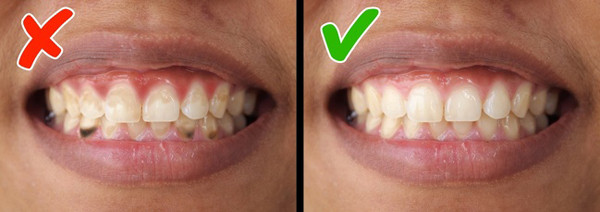 Viêm nha chu Ngoài vấn đề vệ sinh răng miệng kém hoặc hút quá nhiều thuốc, thiếu hụt vitamin D cũng dẫn đến viêm nha chu. Nên ăn nhiềucác sản phẩm từ sữa, gạo nâu, cà chua, đậu, cá, cam, quýt, và nho. Viêm nha chuNgoài vấn đề vệ sinh răng miệng kém hoặc hút quá nhiều thuốc, thiếu hụt vitamin D cũng dẫn đến viêm nha chu. Nên ăn nhiềucác sản phẩm từ sữa, gạo nâu, cà chua, đậu, cá, cam, quýt, và nho.