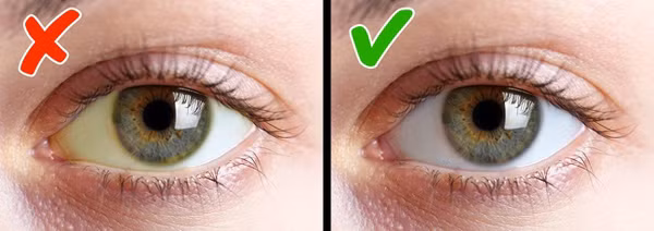 Vàng mắt Lòng trắng mắt có màu vàng là do sự thiếu hụt vitamin B12. Nên bổ sung gan, sữa bò, cá hồi, cá ngừ và thịt cừu.